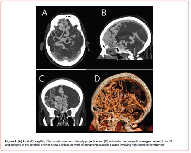 Click here to view Large Figure 1 irispublishers-openaccess-clinical-case-studies