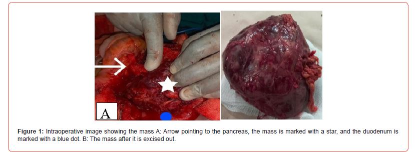 Click here to view Large Figure 1 irispublishers-openaccess-clinical-case-studies