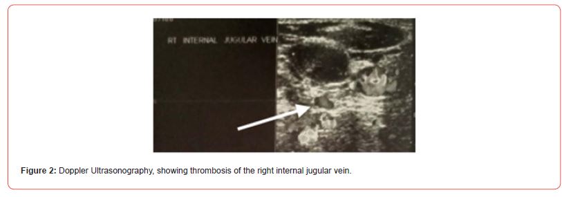Click here to view Large Figure 2 irispublishers-openaccess-clinical-case-studies