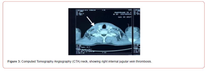 Click here to view Large Figure 3 irispublishers-openaccess-clinical-case-studies