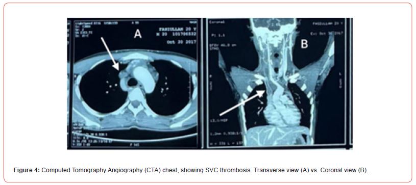 Click here to view Large Figure 4 irispublishers-openaccess-clinical-case-studies