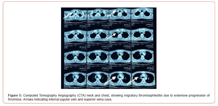 Click here to view Large Figure 5 irispublishers-openaccess-clinical-case-studies