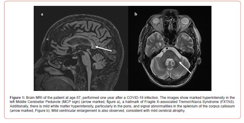 Click here to view Large Figure 1 irispublishers-openaccess-clinical-case-studies