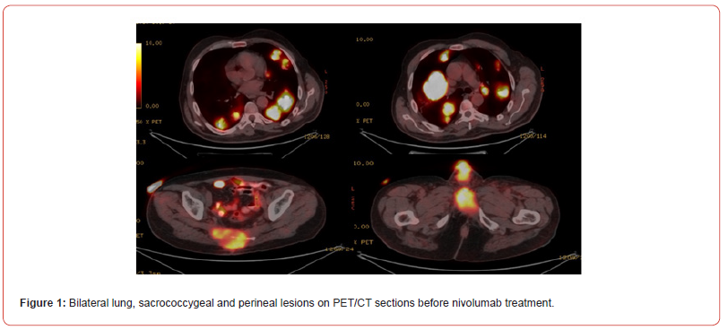 Click here to view Large Figure 1 irispublishers-openaccess-cancer-research-clinical-imaging