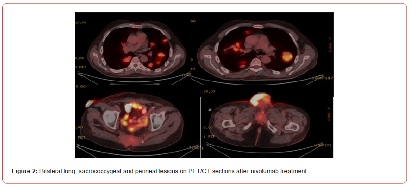 Click here to view Large Figure 2 irispublishers-openaccess-cancer-research-clinical-imaging