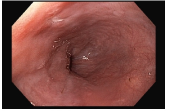 irispublishers-openaccess-gastroenterology-hepatology