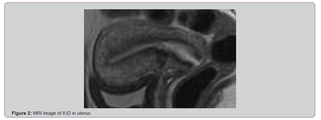 Click here to view Large Figure 2 irispublishers-openaccess-health-sciences-research