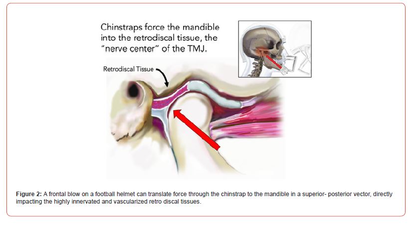 Click here to view Large Figure 2 irispublishers-openaccess-sports-science-medicine