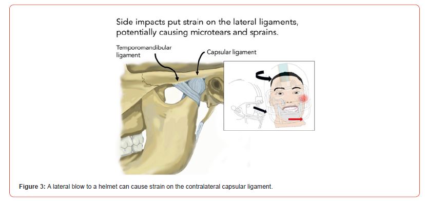 Click here to view Large Figure 3 irispublishers-openaccess-sports-science-medicine