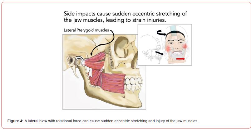Click here to view Large Figure 4 irispublishers-openaccess-sports-science-medicine