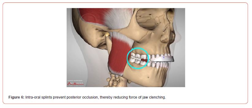 Click here to view Large Figure 6 irispublishers-openaccess-sports-science-medicine