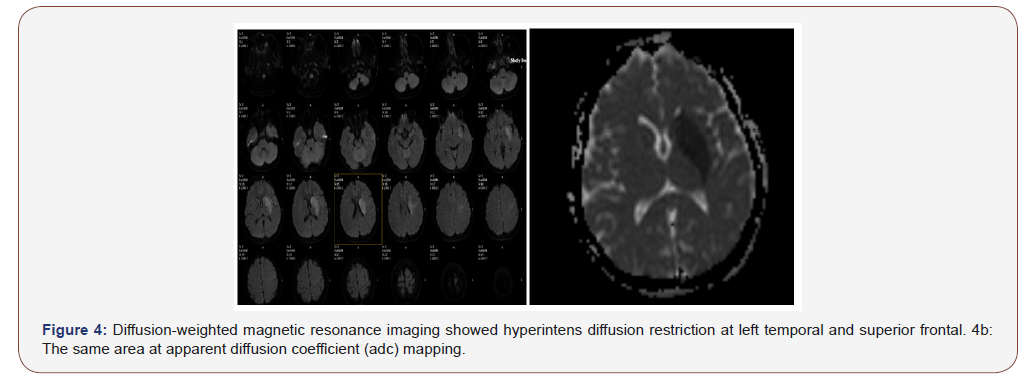Click here to view Large Figure 4 irispublishers-openaccess-neurology-neuroscience