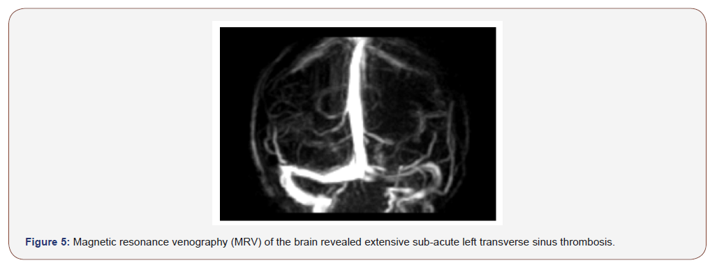Click here to view Large Figure 5 irispublishers-openaccess-neurology-neuroscience