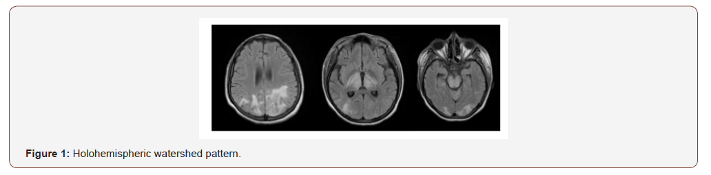irispublishers-openaccess-neurology-neuroscience