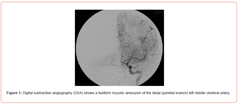 Click here to view Large Figure 1 irispublishers-openaccess-neurology-neuroscience
