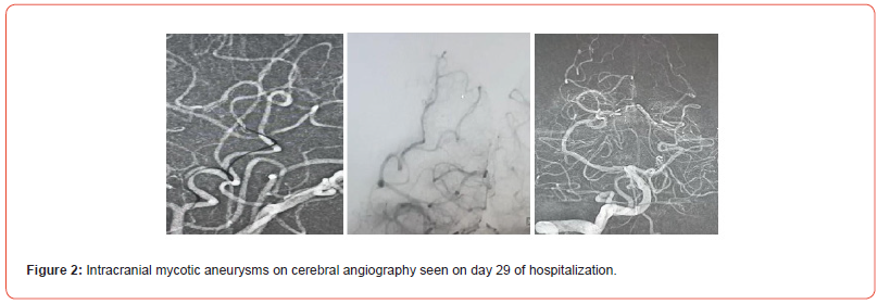 Click here to view Large Figure 2 irispublishers-openaccess-neurology-neuroscience