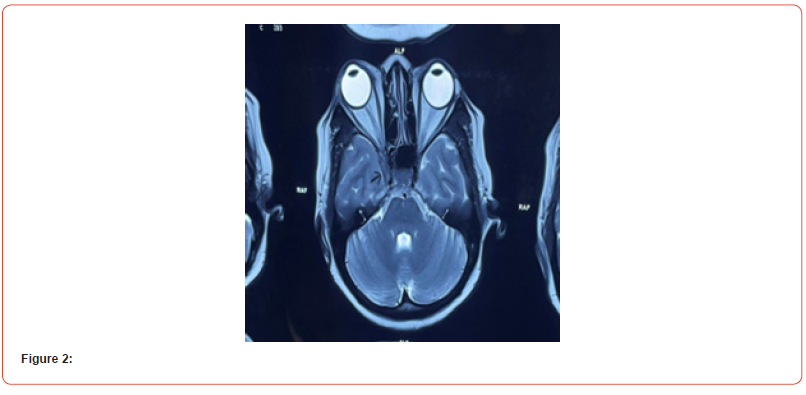 Click here to view Large Figure 2 irispublishers-openaccess-neurology-neuroscience