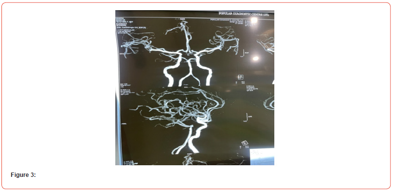 Click here to view Large Figure 3 irispublishers-openaccess-neurology-neuroscience
