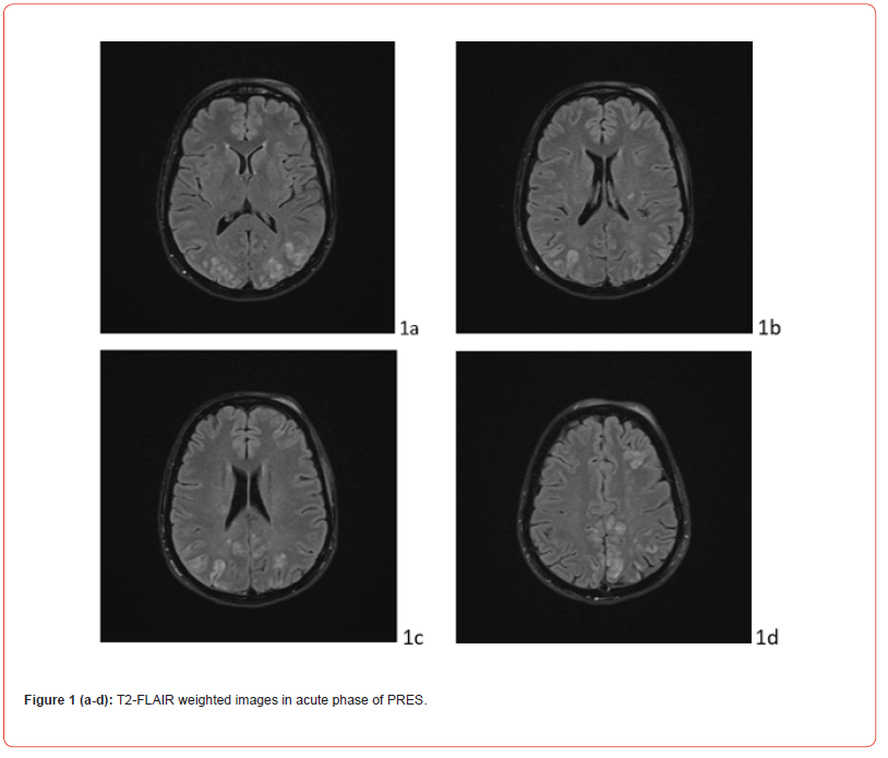Click here to view Large Figure 1 irispublishers-openaccess-neurology-neuroscience