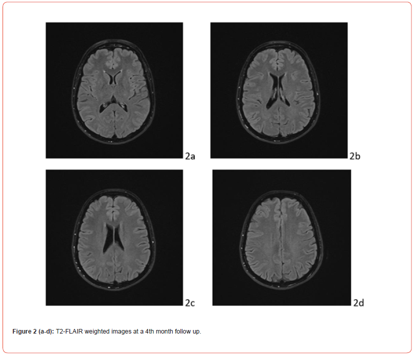 Click here to view Large Figure 2 irispublishers-openaccess-neurology-neuroscience