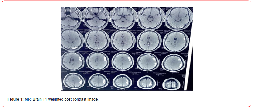 Click here to view Large Figure 1 irispublishers-openaccess-neurology-neuroscience