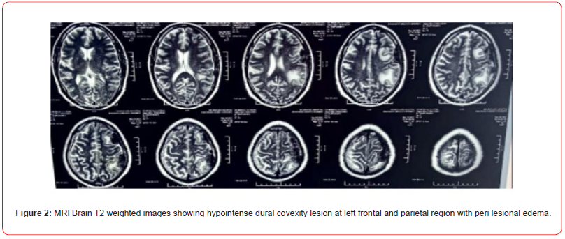 Click here to view Large Figure 2 irispublishers-openaccess-neurology-neuroscience