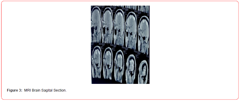 Click here to view Large Figure 3 irispublishers-openaccess-neurology-neuroscience