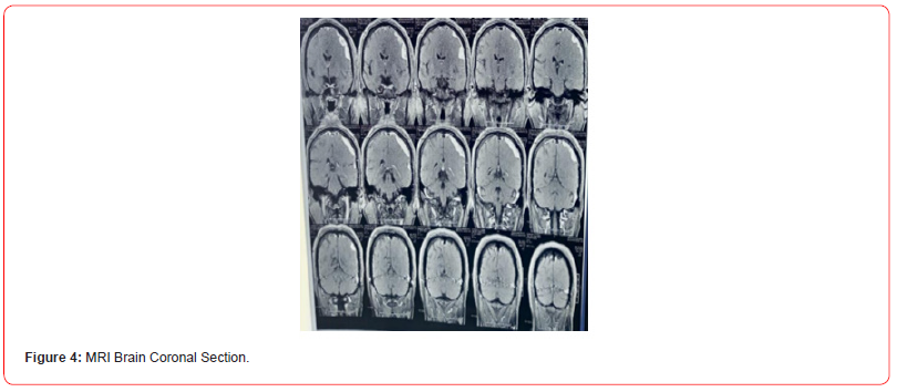 Click here to view Large Figure 4 irispublishers-openaccess-neurology-neuroscience