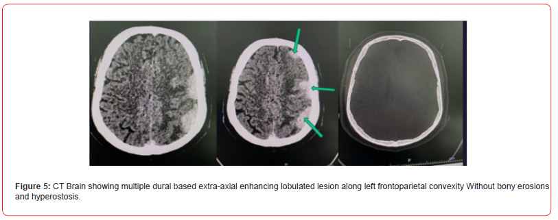 Click here to view Large Figure 5 irispublishers-openaccess-neurology-neuroscience