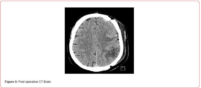 Click here to view Large Figure 6 irispublishers-openaccess-neurology-neuroscience