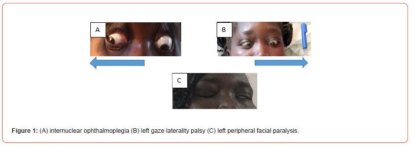 Click here to view Large Figure 1 irispublishers-openaccess-neurology-neuroscience