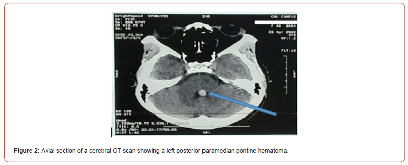Click here to view Large Figure 2 irispublishers-openaccess-neurology-neuroscience