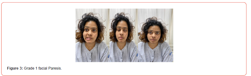 Click here to view Large Figure 3 irispublishers-openaccess-neurology-neuroscience