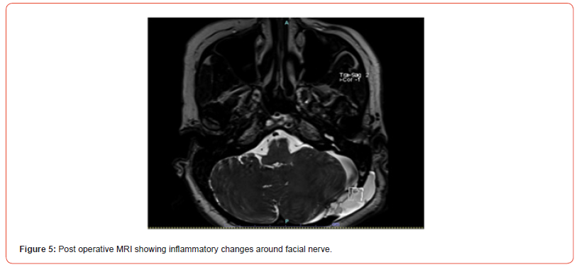 Click here to view Large Figure 5 irispublishers-openaccess-neurology-neuroscience