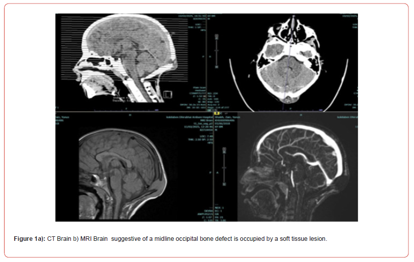 Click here to view Large Figure 1 irispublishers-openaccess-neurology-neuroscience