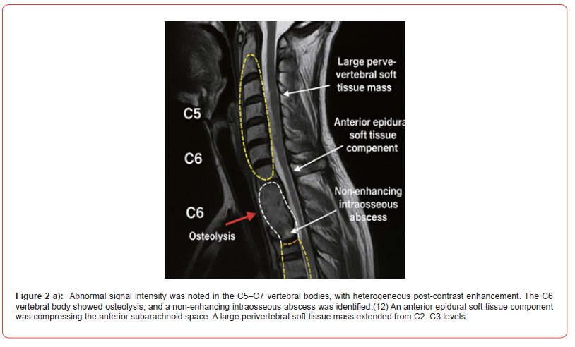 Click here to view Large Figure 2a irispublishers-openaccess-neurology-neuroscience