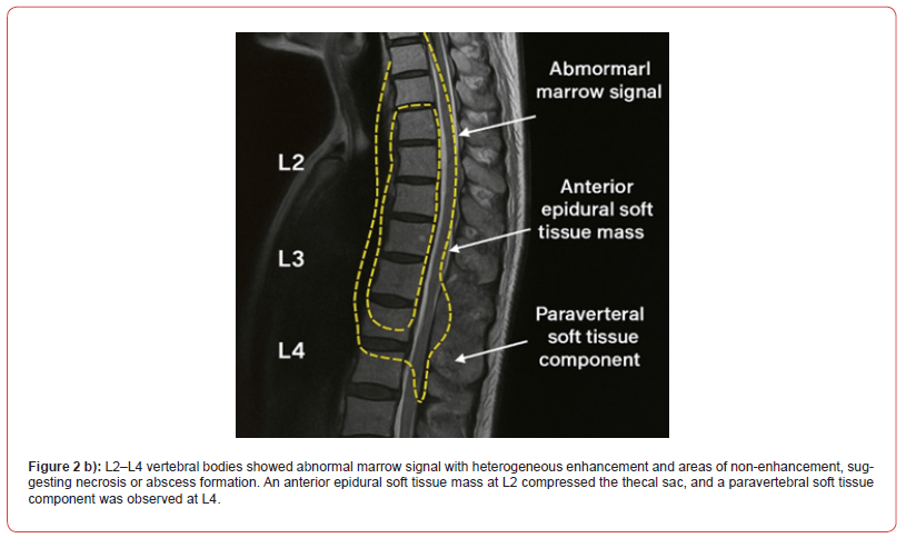 Click here to view Large Figure 2b irispublishers-openaccess-neurology-neuroscience