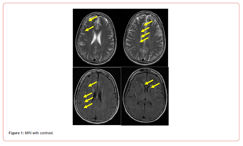Click here to view Large Figure 1 irispublishers-openaccess-neurology-neuroscience