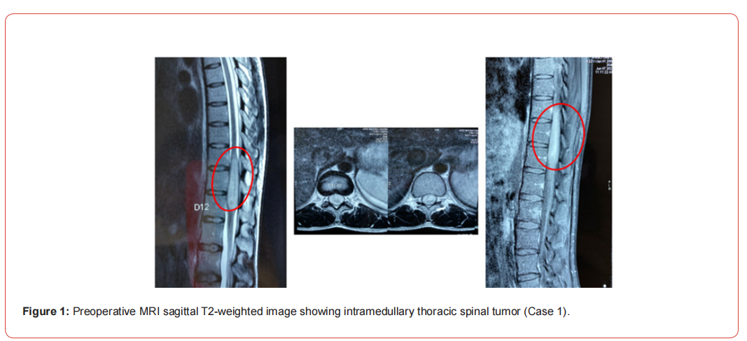 Click here to view Large Figure 1 irispublishers-openaccess-neurology-neuroscience