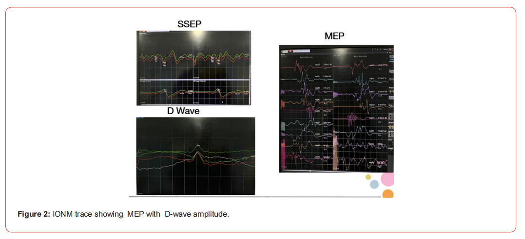 Click here to view Large Figure 1 irispublishers-openaccess-neurology-neuroscience