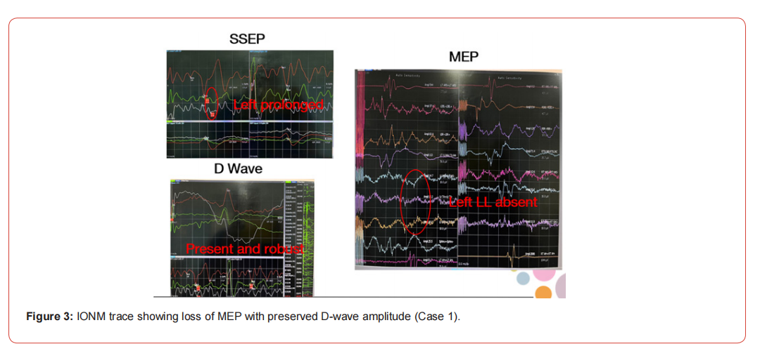 Click here to view Large Figure 1 irispublishers-openaccess-neurology-neuroscience