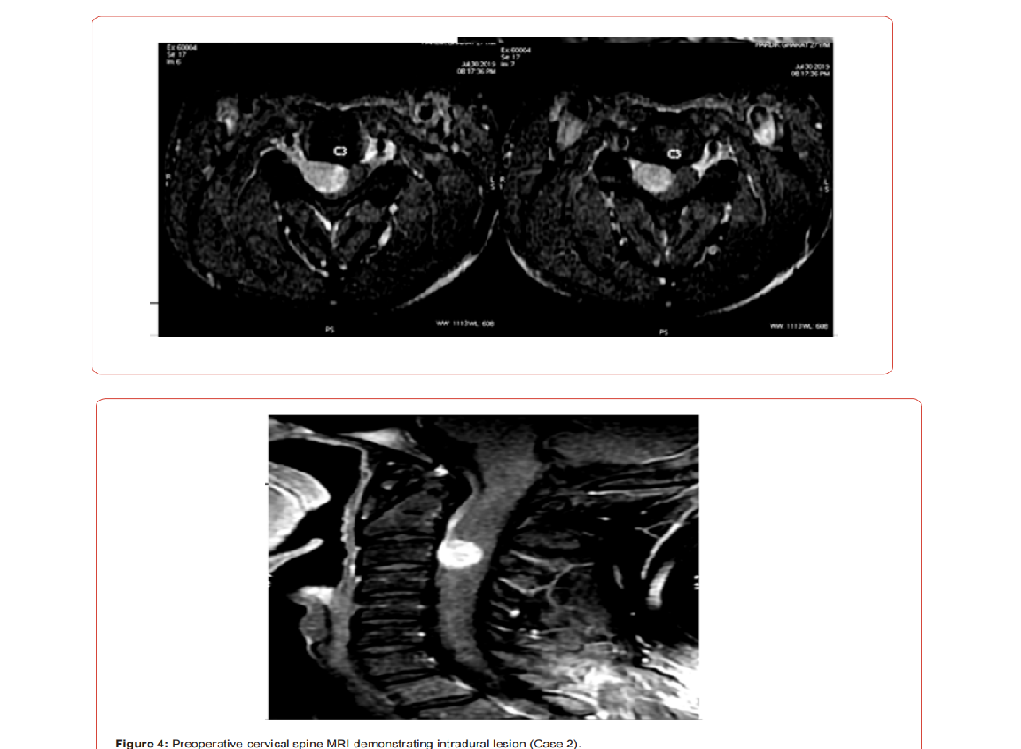 Click here to view Large Figure 1 irispublishers-openaccess-neurology-neuroscience
