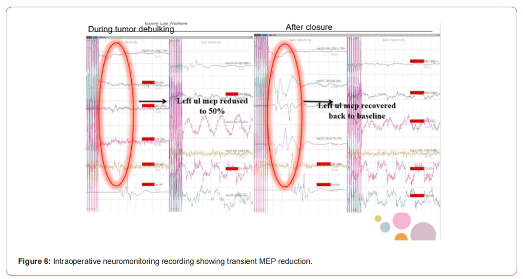 Click here to view Large Figure 1 irispublishers-openaccess-neurology-neuroscience