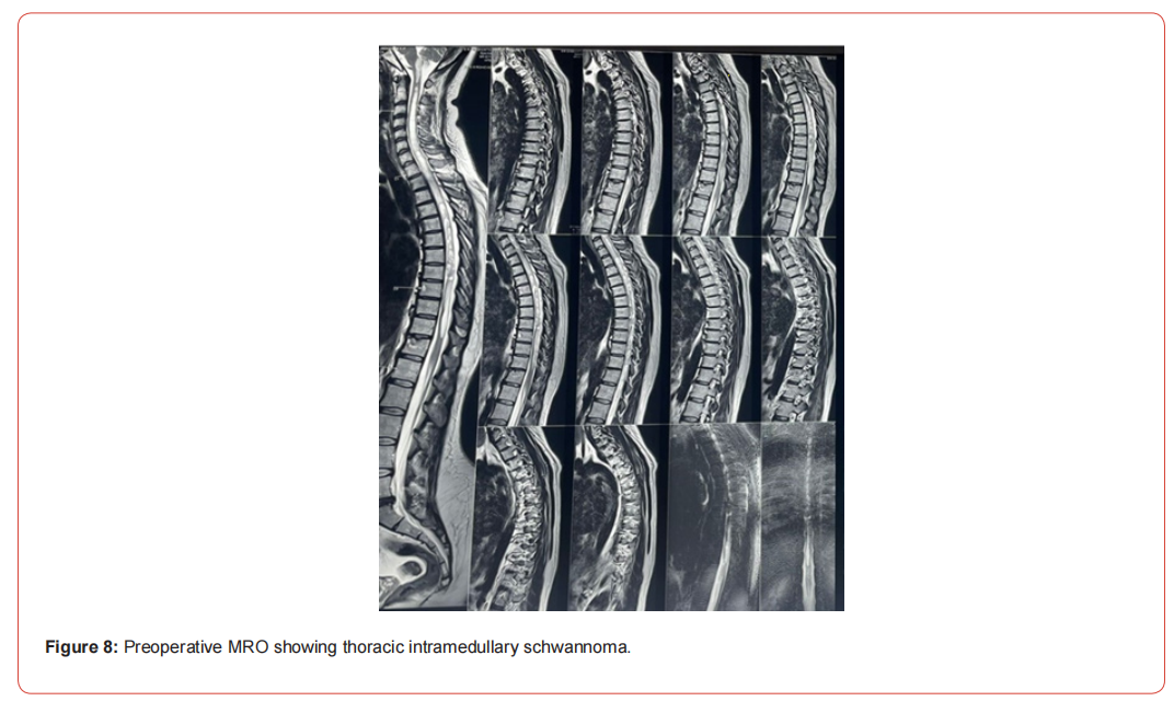 Click here to view Large Figure 1 irispublishers-openaccess-neurology-neuroscience