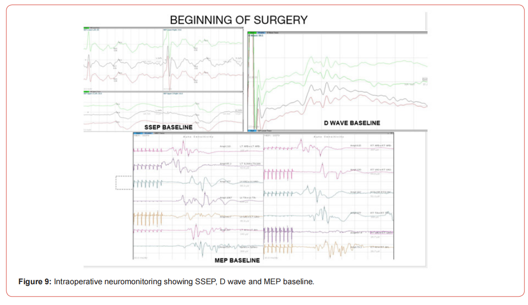 Click here to view Large Figure 1 irispublishers-openaccess-neurology-neuroscience