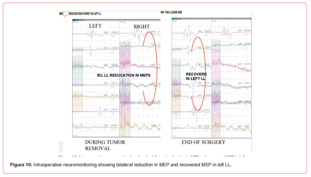 Click here to view Large Figure 1 irispublishers-openaccess-neurology-neuroscience