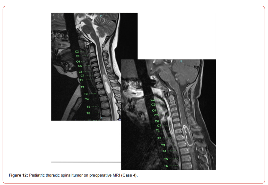 Click here to view Large Figure 1 irispublishers-openaccess-neurology-neuroscience