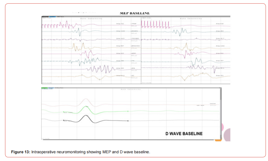 Click here to view Large Figure 1 irispublishers-openaccess-neurology-neuroscience
