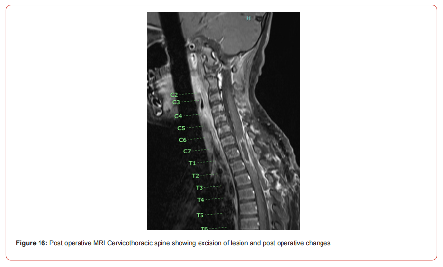 Click here to view Large Figure 1 irispublishers-openaccess-neurology-neuroscience