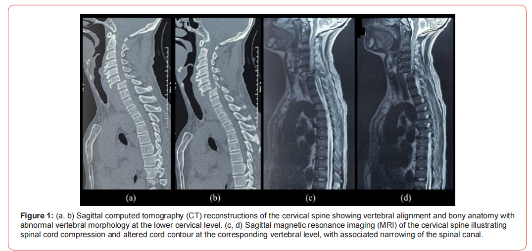 Click here to view Large Figure 1 irispublishers-openaccess-neurology-neuroscience